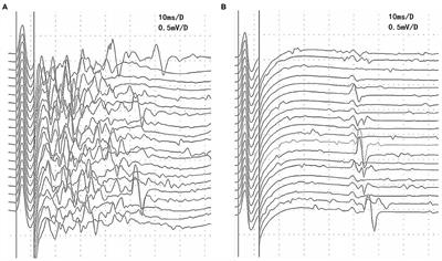 Afterdischarges in Myasthenia Gravis